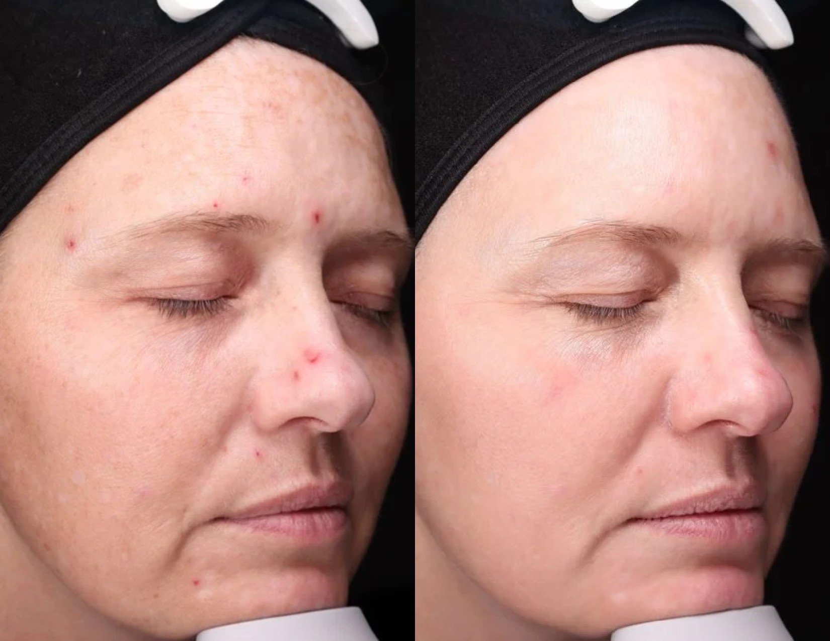 Elle_Skin-Beauty-Co-BBL-Before-After-mln-In-Florence-KY