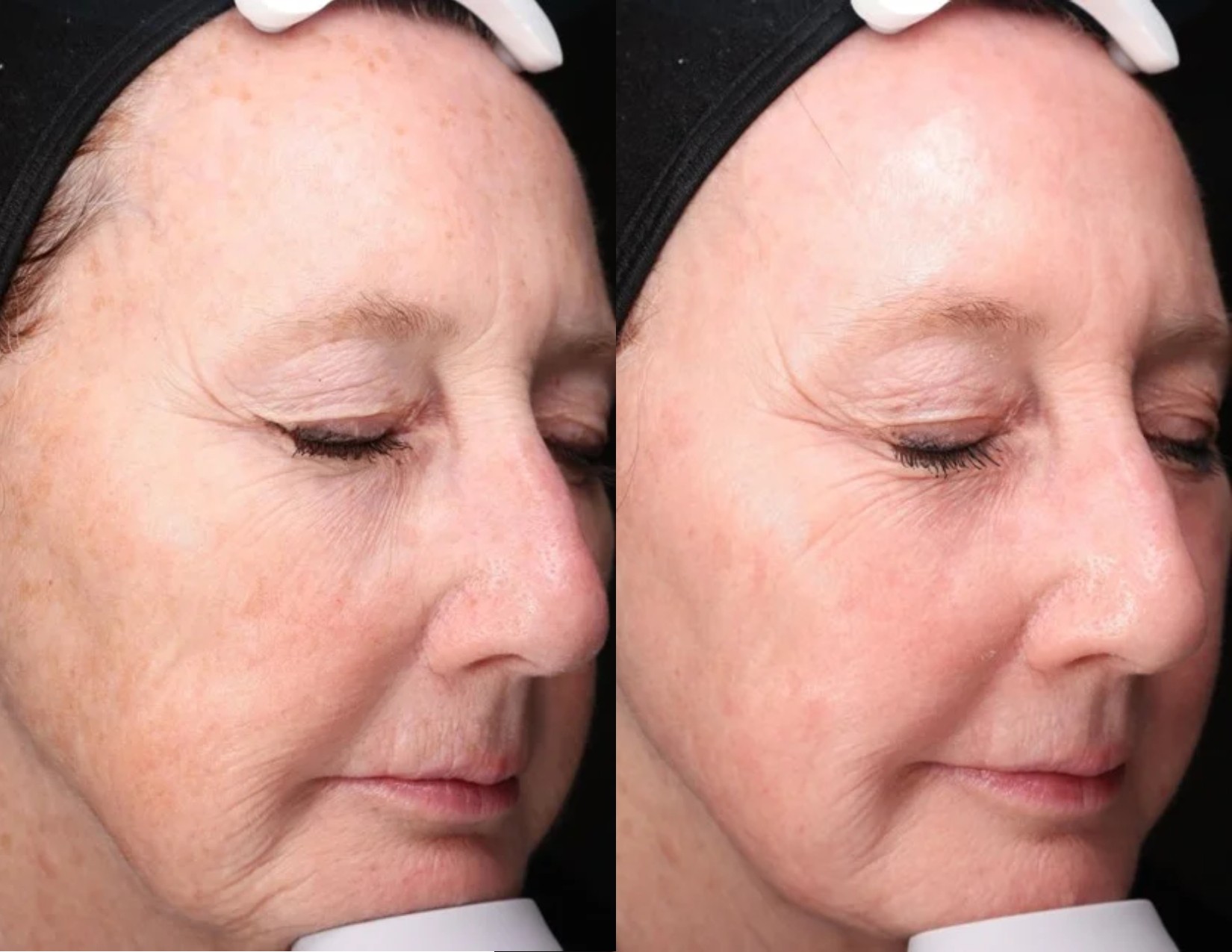 Elle_Skin-Beauty-Co-BBL-Before-After-nlw-In-Florence-KY