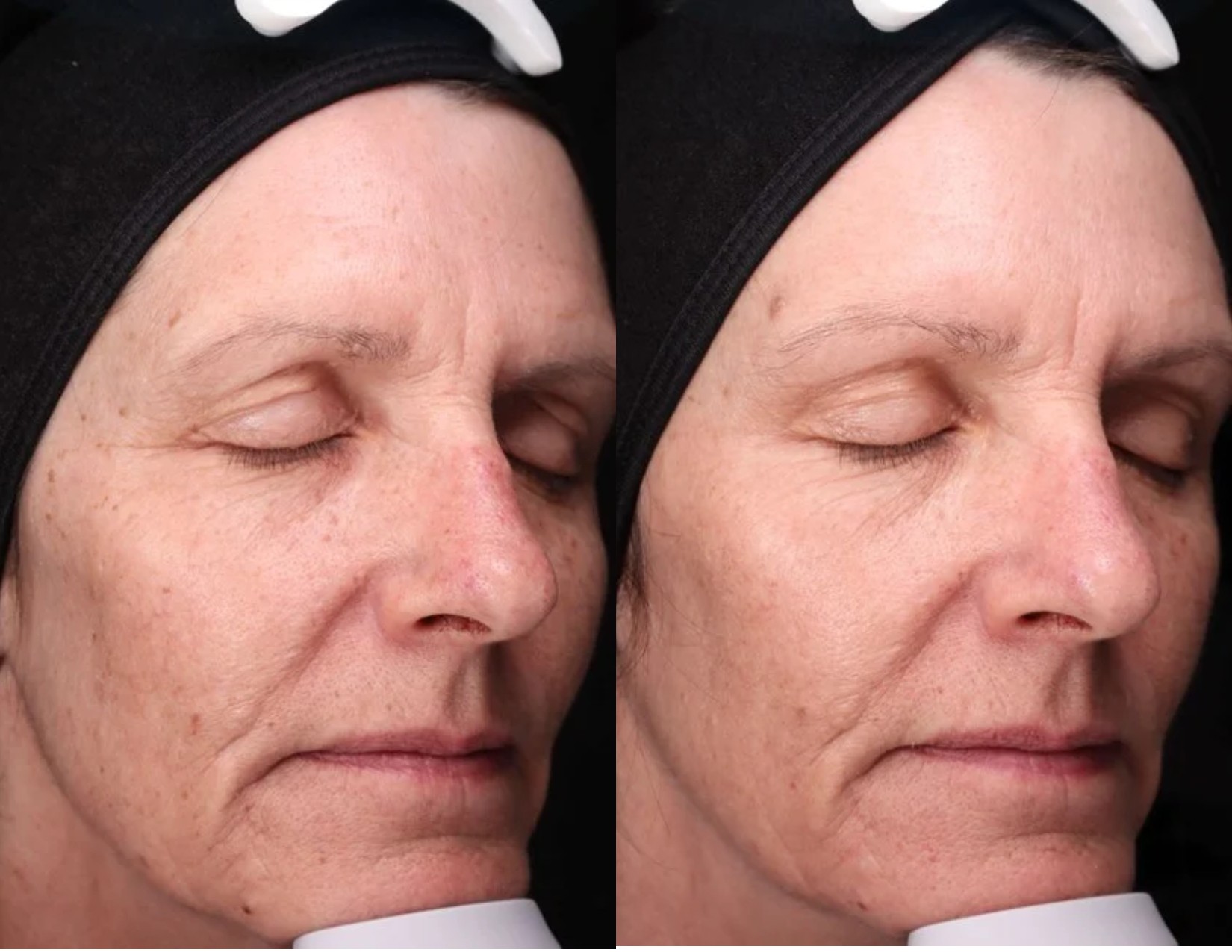 Elle_Skin-Beauty-Co-BBL-Before-After-tln-In-Florence-KY