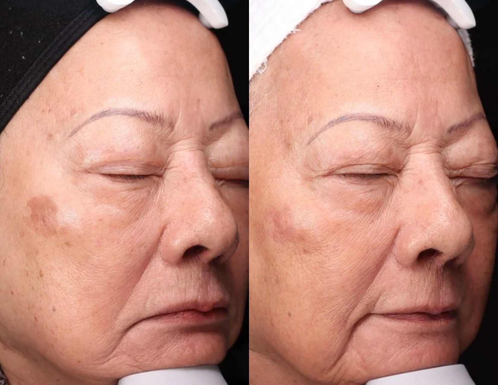 Elle_Skin-Beauty-Co-BBL-Before-After-xln-In-Florence-KY