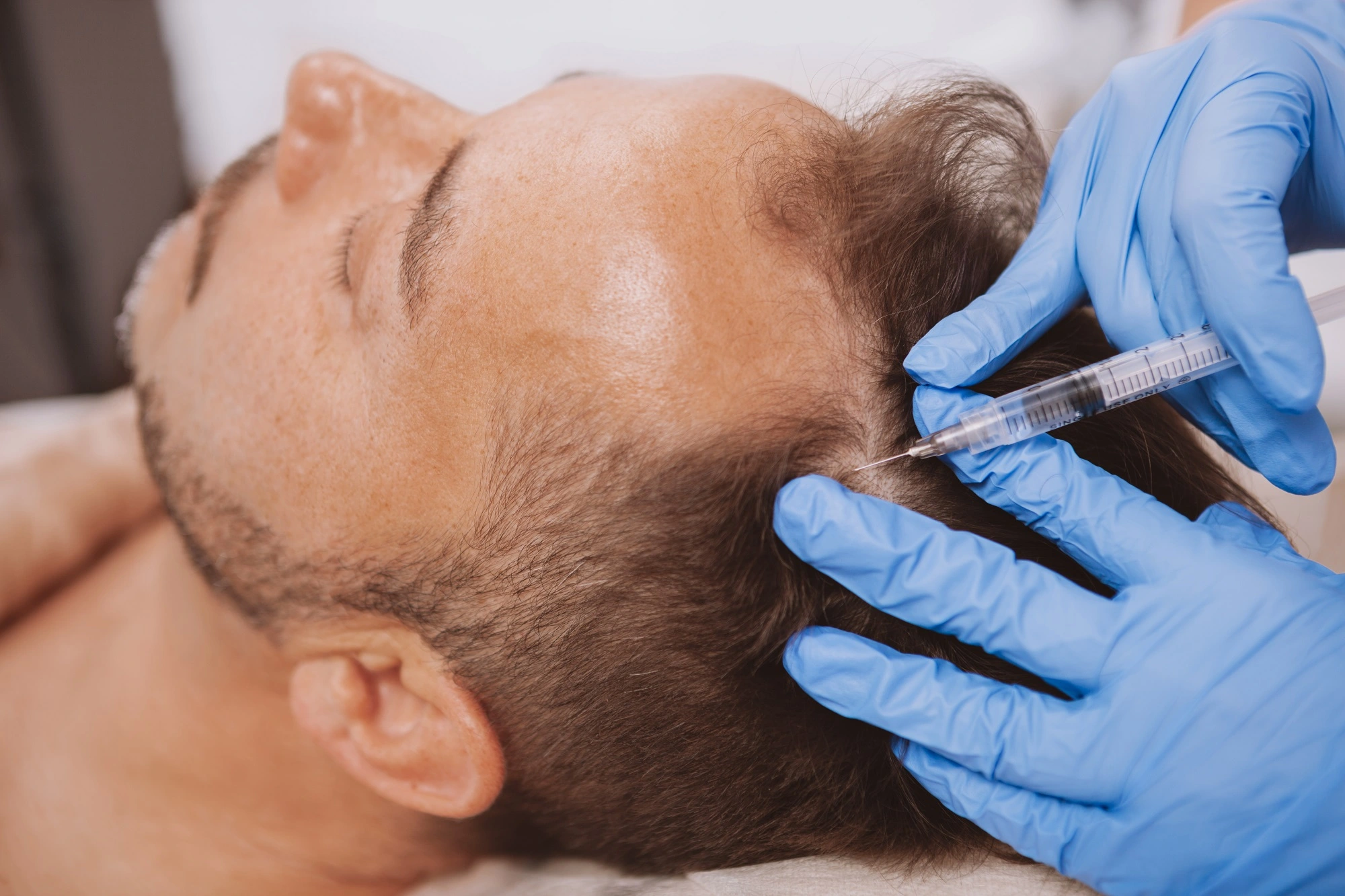 NATURAL GROWTH FACTORS SCALP INJECTIONS IN NORTHERN KENTUCKY,KY | Elle Skin & Beauty Co.