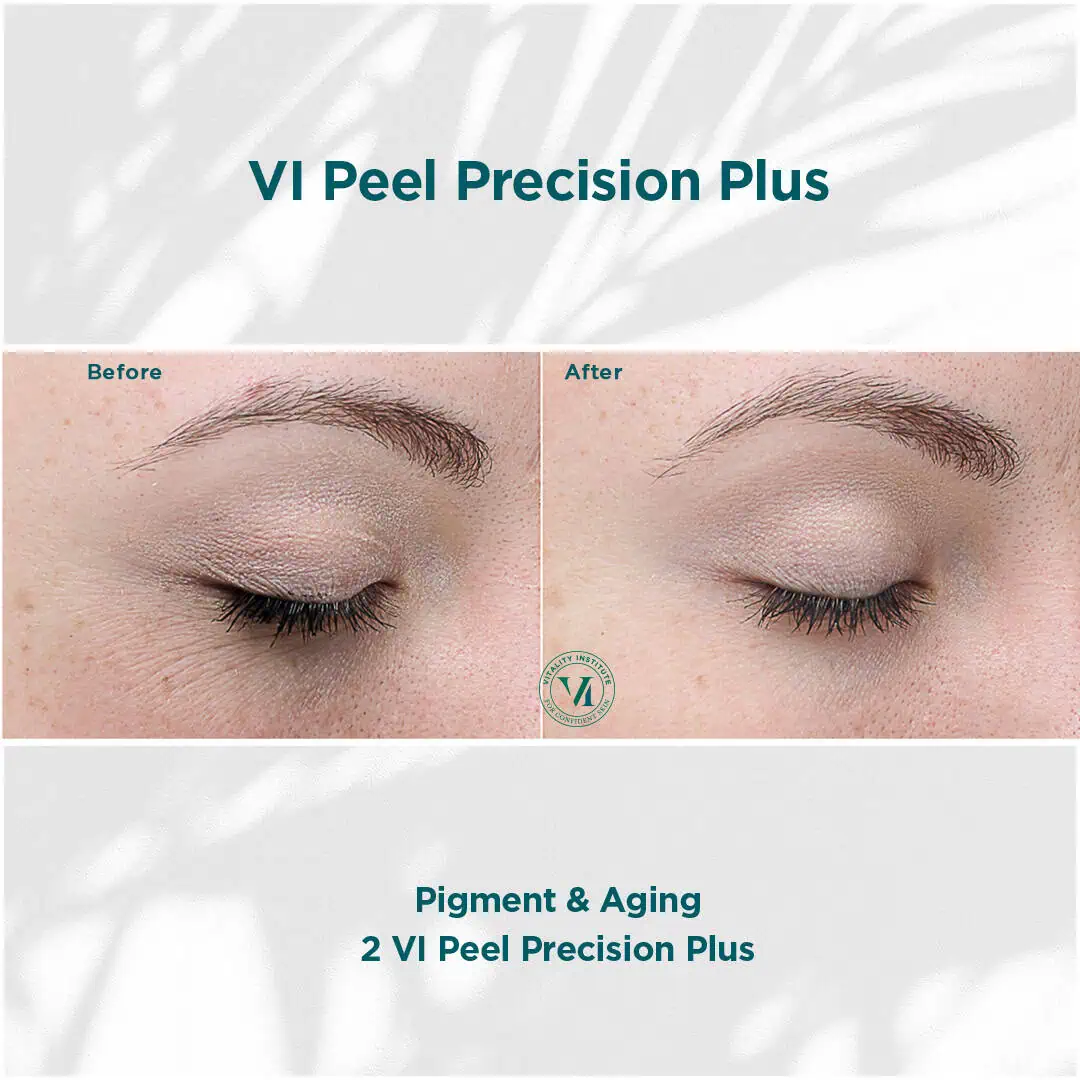 Pigmentation due to aging | before and after treatment photo | Elle Skin & Beauty Co. | Florence, KY
