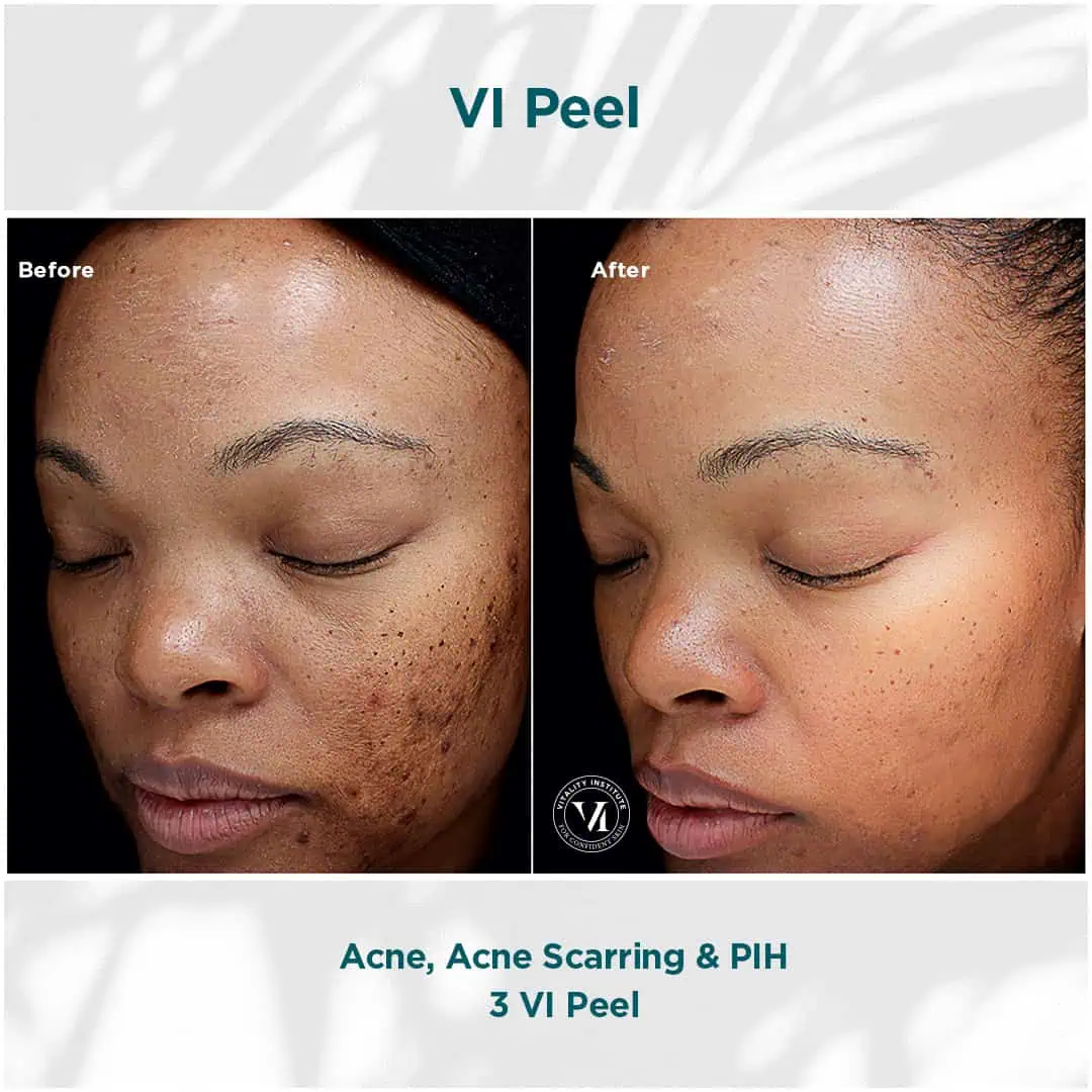 Acne, scars treatment | before and after photo | Elle Skin & Beauty Co. | Florence, KY