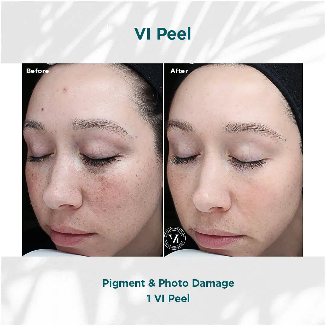 Pigmentation and photo damage treatment | before and after photo | Elle Skin & Beauty Co. | Florence, KY