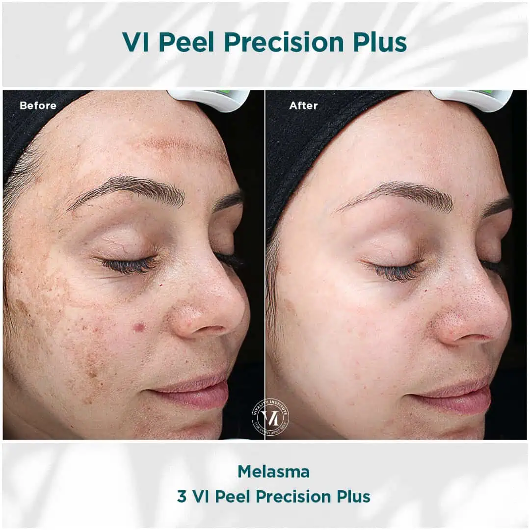 Melasma treatment using VI Peel Precision Plus | before and after photo | Elle Skin & Beauty Co. | Florence, KY