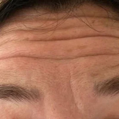 Elle Skin_Beauty & Co_Wrinkle Relaxers Before After In Florence, KY