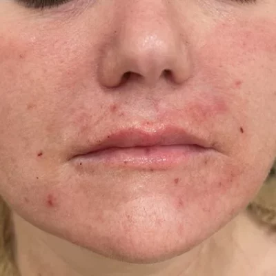 Elle_Skin Beauty & Co PDO Before After-f-In Florence, KY
