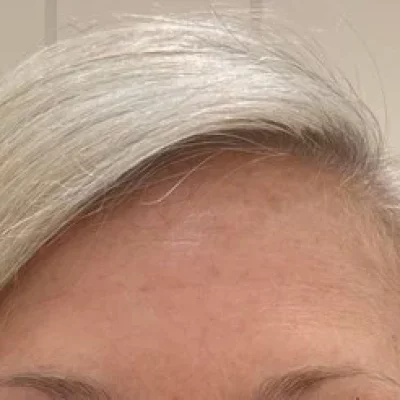 Elle_Skin_Beauty & Co Wrinkle Relaxers-Before After In Florence, KY