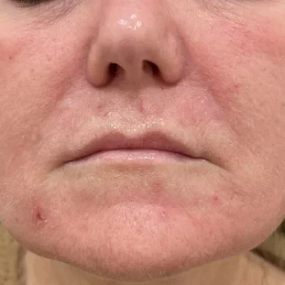 Elle_Skin Beauty & Co PDO Before After-e-In Florence, KY